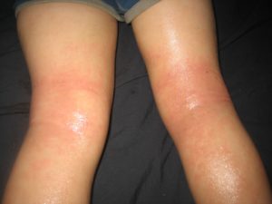 Wet wrap therapy provided some relief from the itch of eczema for Tristan Roberge.