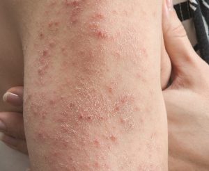 Celiac That S Skin Deep The Mysterious Rash Sparked By Gluten
