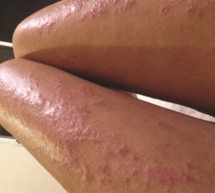 Dupilumab therapy targets IL-4 and IL-13 proteins (called cytokines) that are drivers of inflammation in atopic dermatitis.