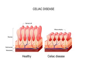 Celiac disease: normal villi vs. villous atrophy.
